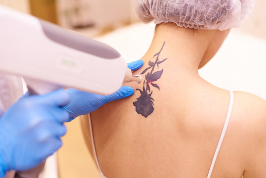 Gratis Intro: Tattoo Verwijdering voor Salons (online)